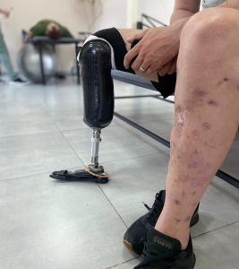 Ukrainian amputee man who lost his leg with prosthetic limb
