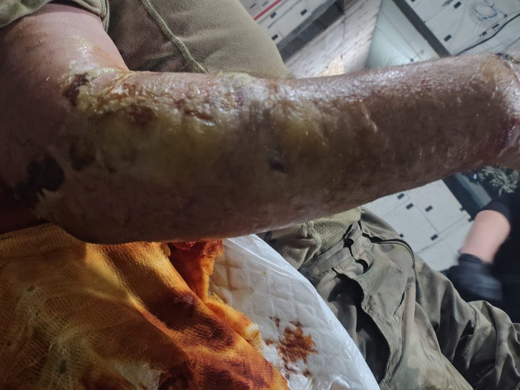 Swollen arm after wound
