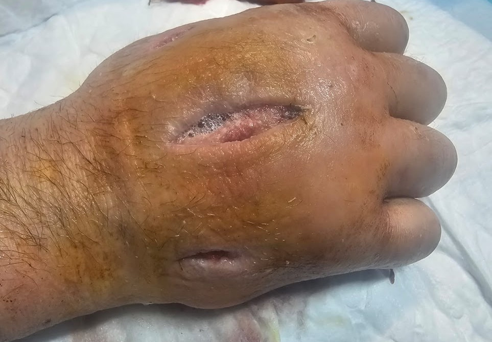 Swollen palm